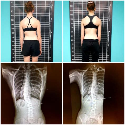 Scoliosis X Ray Before And After