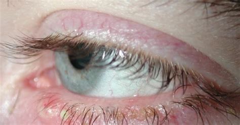 How to treat Blepharitis at home?