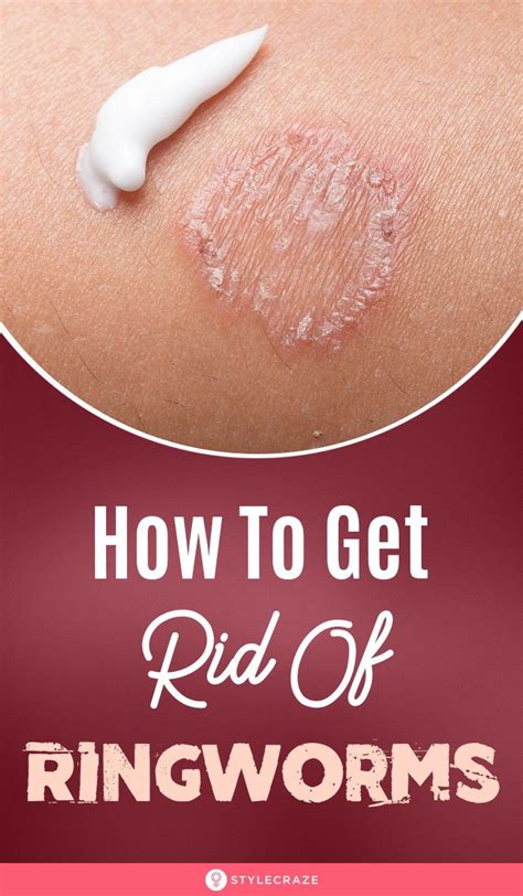 10 best natural home remedies for ringworm treatment – Artofit