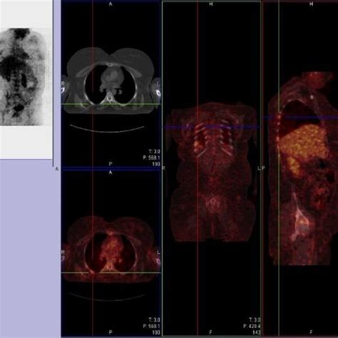 PET-scan for differential diagnosis of lymphoma reveals increased... | Download Scientific Diagram