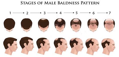 Androgenetic alopecia female & male causes, diagnosis & treatment