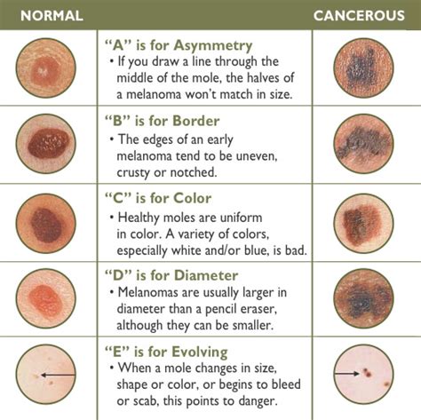 Symptoms of Melanoma: Learn the Early Signs of Skin Cancer