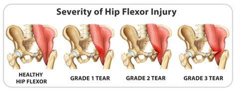 Hip Flexor Strain: Signs, Causes, Treatment and Recovery | IYTmed.com