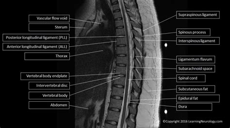 Approach to MRI Spine | LearningNeurology.com