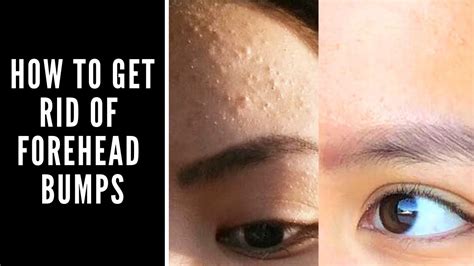 How to Get Rid of Forehead Bumps - YouTube