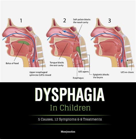 Dysphagia In Children – Causes, Symptoms & Treatment