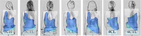 Types of Scoliosis Braces | Scoliosis SOS