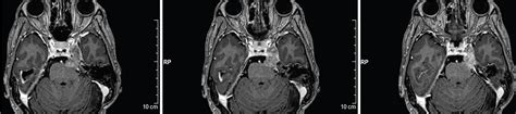 Cavernous sinus/petroclival meningioma – immediate postoperative radiosurgery for residual ...