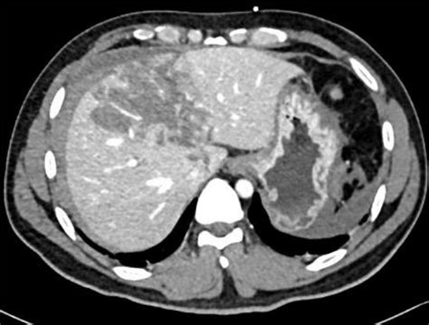 Contrast-enhanced CT scan showing Grade IV liver laceration. | Download Scientific Diagram