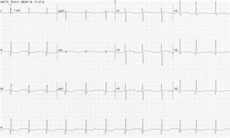 Hypokalemia Ecg Strip