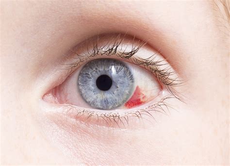 Scratched Eye Symptoms and Treatment - Diamond Vision