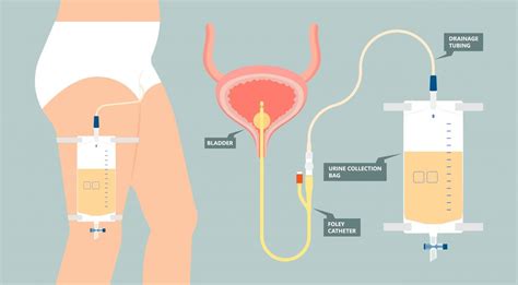 What's a Foley catheter? | Roswell Park Comprehensive Cancer Center - Buffalo, NY