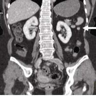 Contrasted axial CT: a. Accessory spleen is monitored, b. Accessory... | Download Scientific Diagram