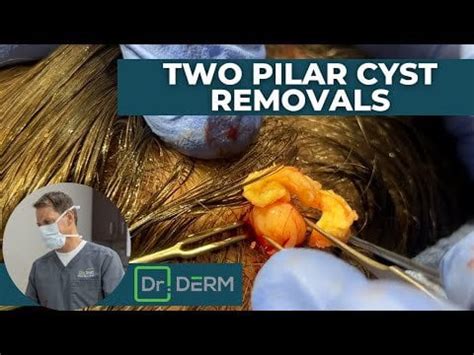 Two Pilar Cyst Removals | Dr. Derm : r/popping