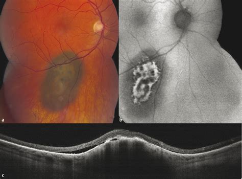 Choroidal Nevus Melanoma