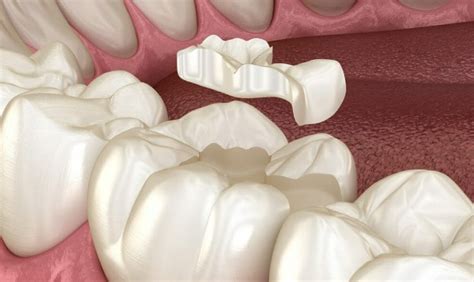 The Procedure for Cavity Filling - Kelly Dental