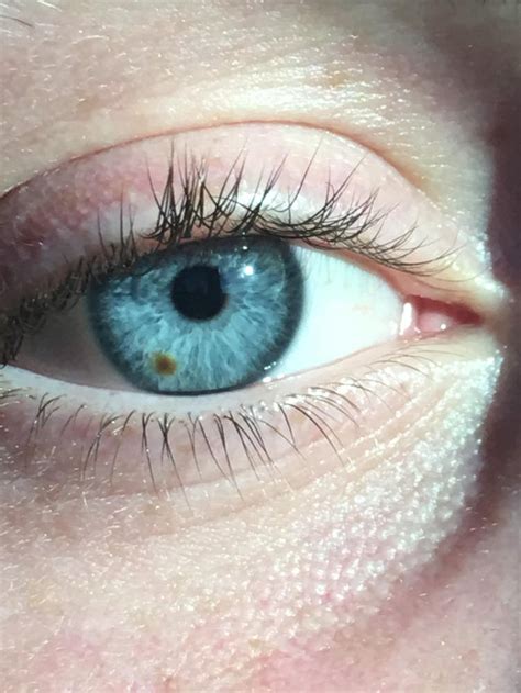 My friends “eye freckle” : r/mildlyinteresting