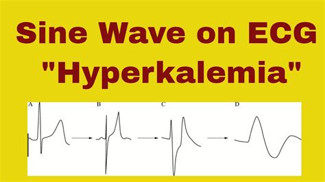 Sine Wave Hyperkalemia Ecg Changes