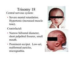 edwards syndrome symptoms - DriverLayer Search Engine