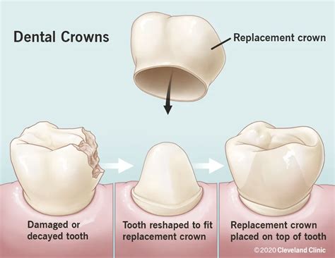 Efficient Crown Repair in Nashville | Bellevue, TN Dentist | WPFD