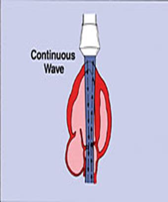 week 3.1- Aortic Regurgitation Severity - Indirect Signs Flashcards ...