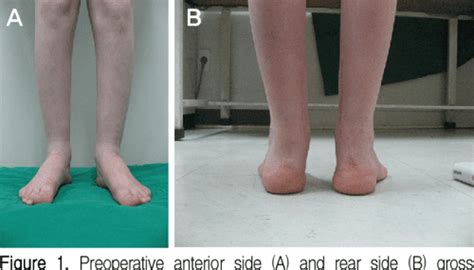 Figure 1 from Treatment of Calcaneovalgus Deformity Following Operative Treatment of Diplegic ...