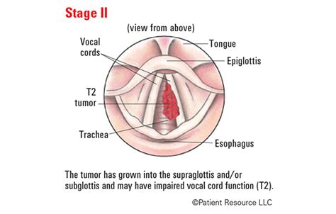 Head & Neck Laryngeal Cancer