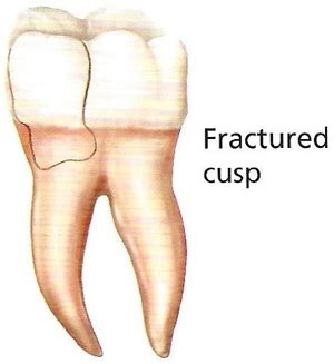 Cracked Tooth Symptoms | How Can I Tell If My Tooth Is Cracked?