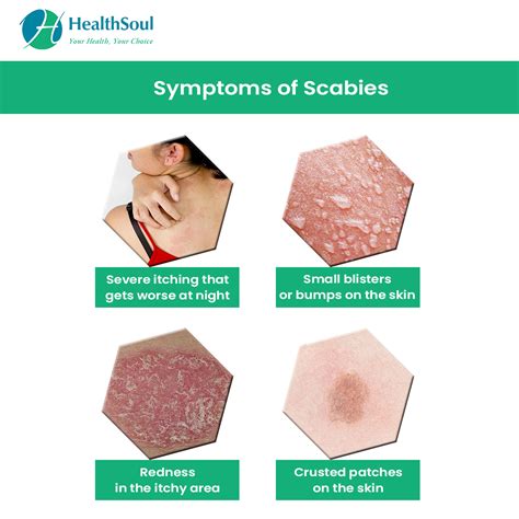 Scabies: Diagnosis & Treatment – Healthsoul