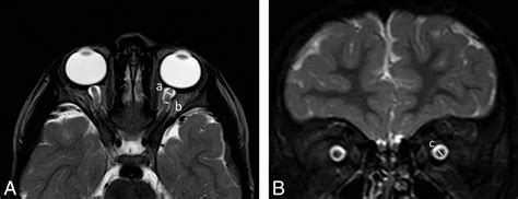 Normal Optic Nerve Mri