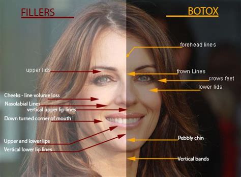 Botox Injection for Wrinkles, Philadelphia | Best Botox Doctors, PA