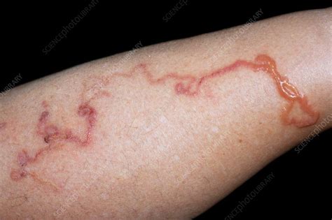 Cutaneous larva migrans infection - Stock Image - C029/8986 - Science Photo Library