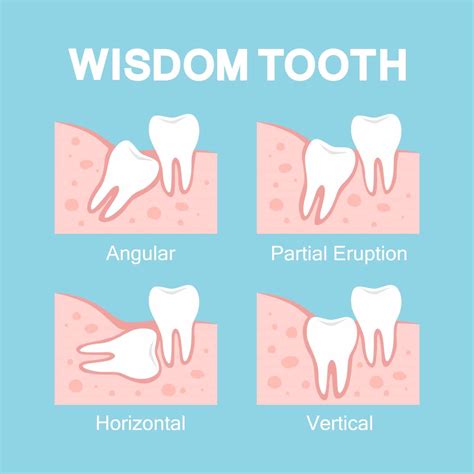 Wisdom Teeth Removal Cost Breakdown - Teeth Wisdom