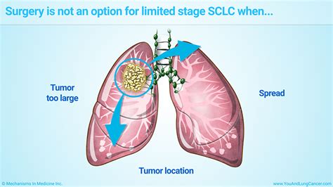 Slide Show - Treatment and Management of Small Cell Lung Cancer (SCLC)