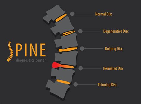 Herniated Disc Treatment Options: Surgical vs. Non-Surgical