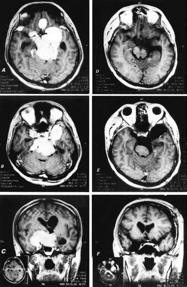 49 Radical Total Resection of a Giant Petroclival Meningioma | Neupsy Key