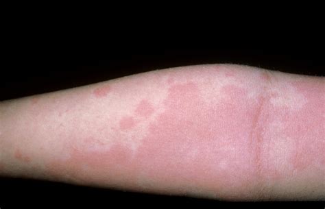 Severe Hives Treatment (Xolair and Cyclosporine) - Los Angeles Allergist