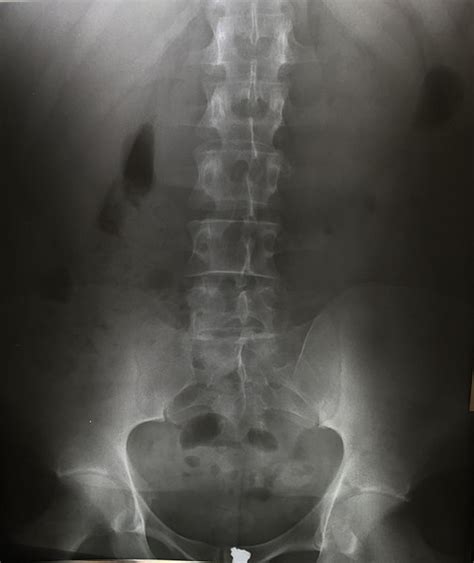 Lumbar X Ray Technique