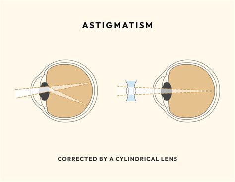 Glasses for Astigmatism Explained | Blog | Eyebuydirect