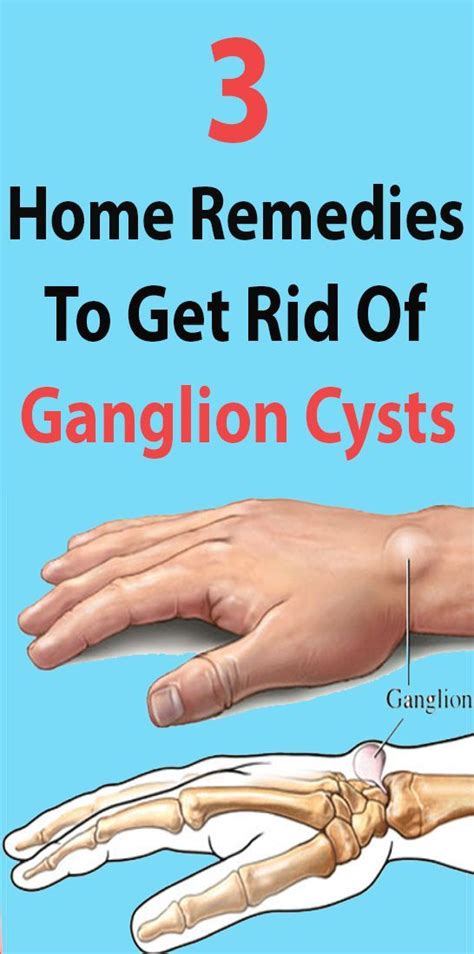 How To Get Rid Of Ganglion Cyst Wrist - Duane Pickrell Kapsels