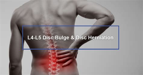 Slipped Disc Symptoms, Causes And Treatment Disc Prolapse, 52% OFF