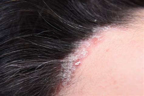 Plaque Psoriasis Ear