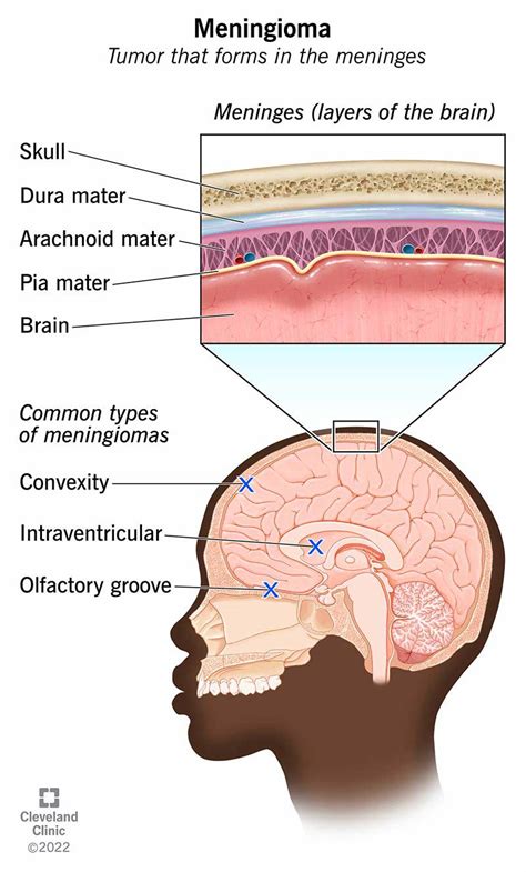 Meningioma: What It Is, Causes, Symptoms Treatment, 58% OFF