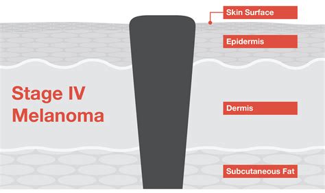 Malignant Melanoma Stage 1