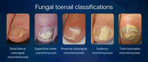 Types of Toenail Fungus – Bespoke Health