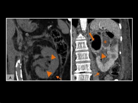 Complicated pyelonephritis. A. Unenhanced coronal CT scan shows gas in ...