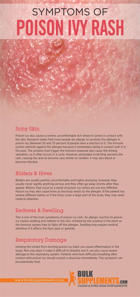 Poison Ivy Rash: Stages, Causes, Symptoms & Treatment