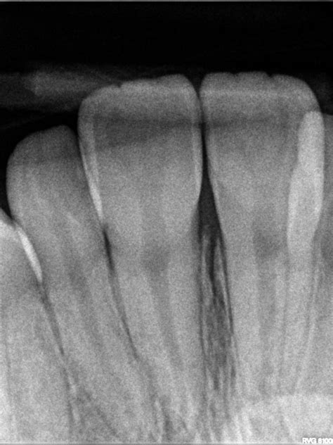 What are the different types of Digital Dental X-rays? | Palms Dentist ...