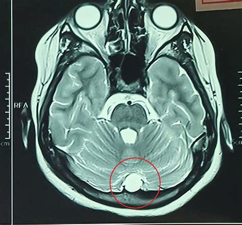 ARACHNOID CYST | TREATMENT | Homeopathy