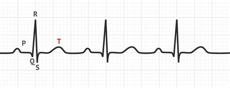 The T Wave | ECG Basics - MedSchool